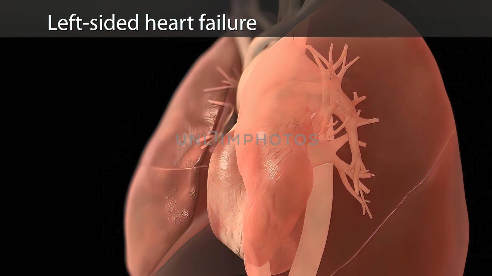 It means respiratory failure due to heart failure, edema, growth in the liver and obvious disease. 3D illustration
