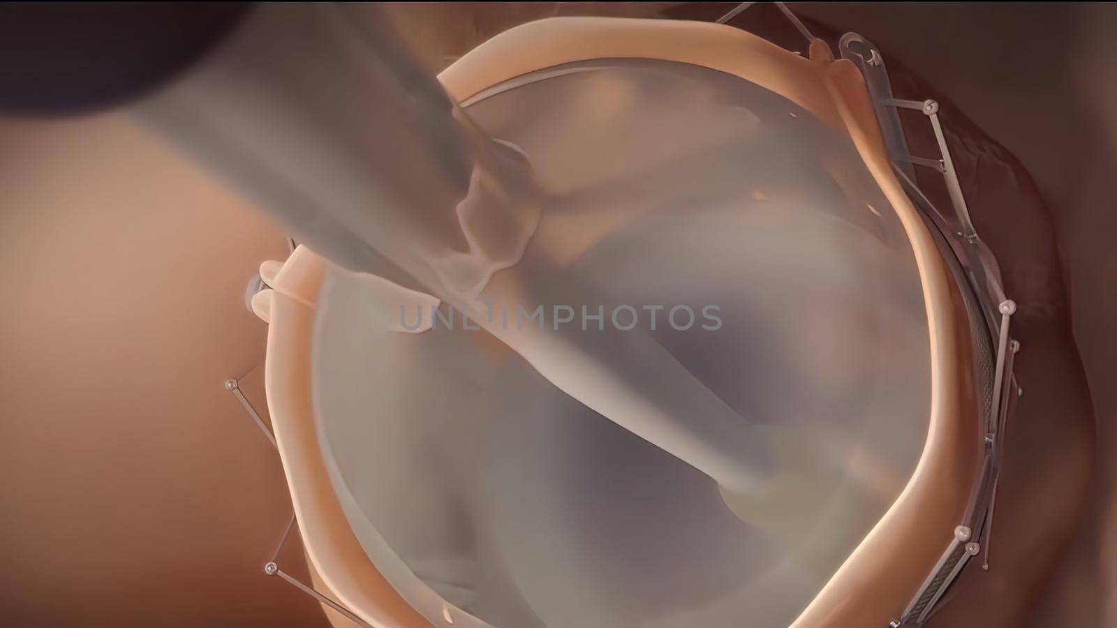 An artificial heart valve is inserted instead of a dysfunctional heart valve. 3D illustration