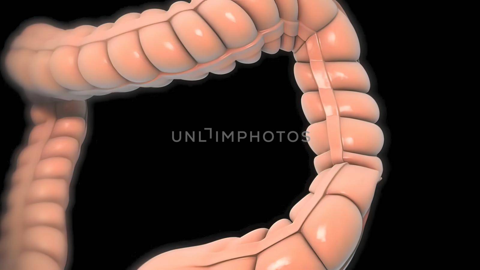 Magnifying glass of intestinal cancer. Tumor formation and growth 3D illustration