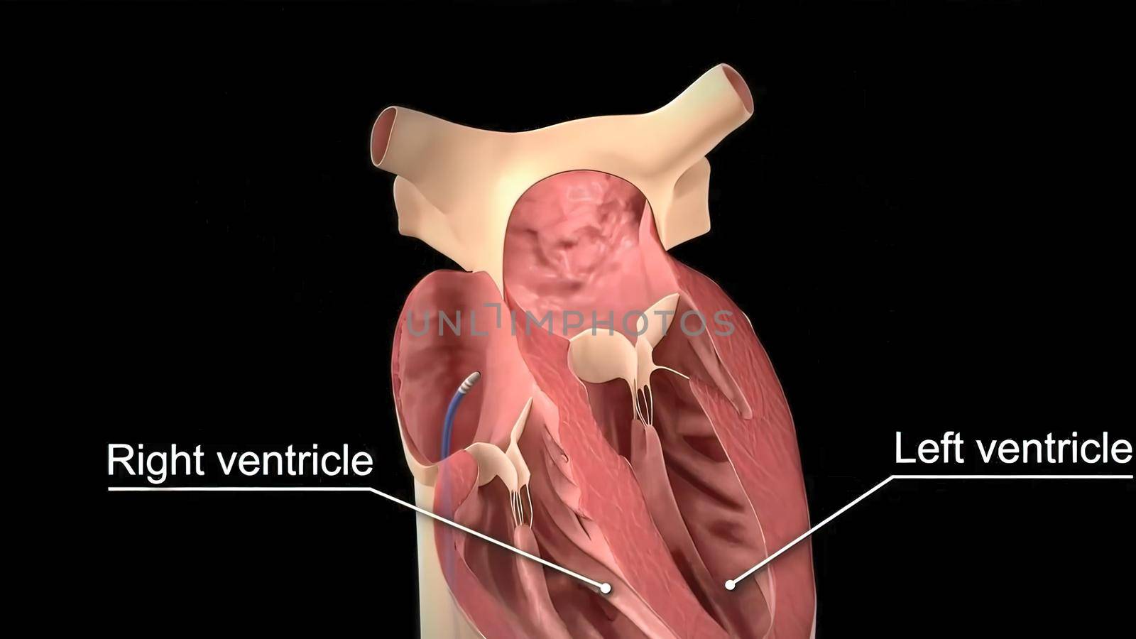 Catheter ablation 3D Medical illustration by creativepic