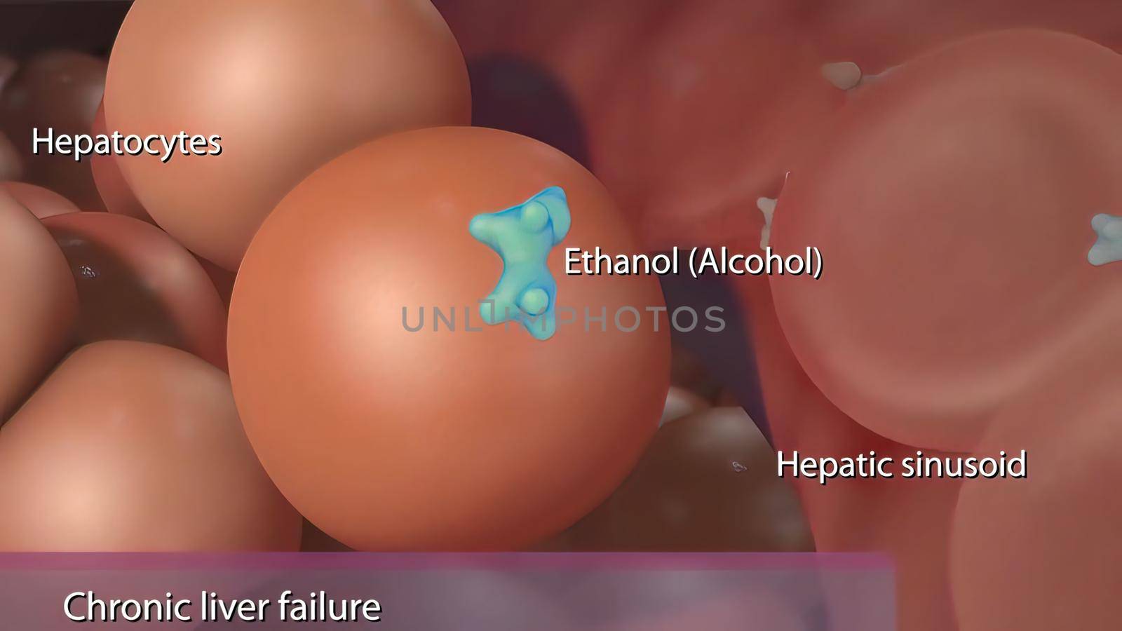 Chronic liver failure caused by the hepatitis B virus. 3D illustration