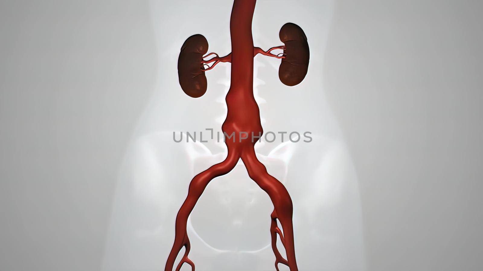 balloon angioplasty procedure with stent in vein 3D illustration