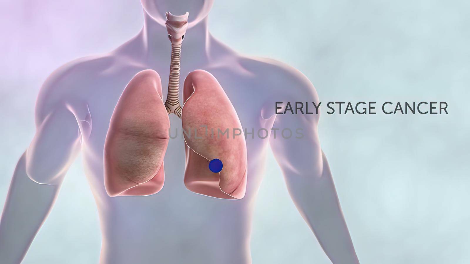 Early stage cancer and advanced stages of cancer. 3D illustration