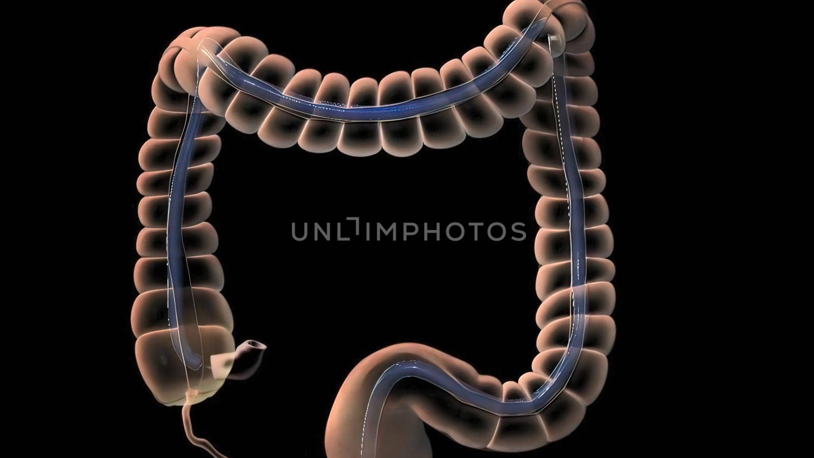 Colonoscopy Biopsy Of The Gastrointestinal Tract In Patients 3D illustration