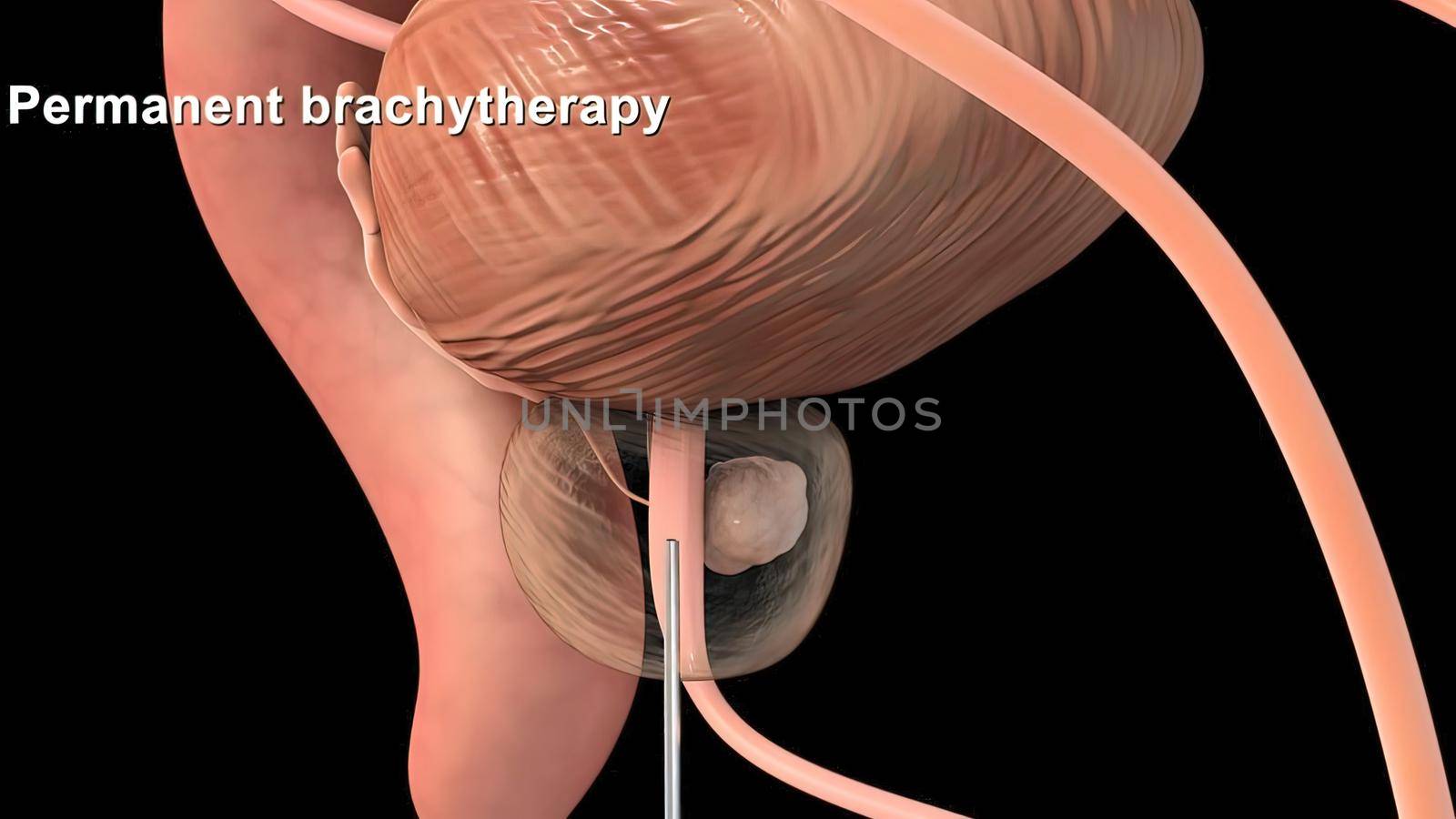 Medically accurate 3d illustration of prostate cancer 3D illustration