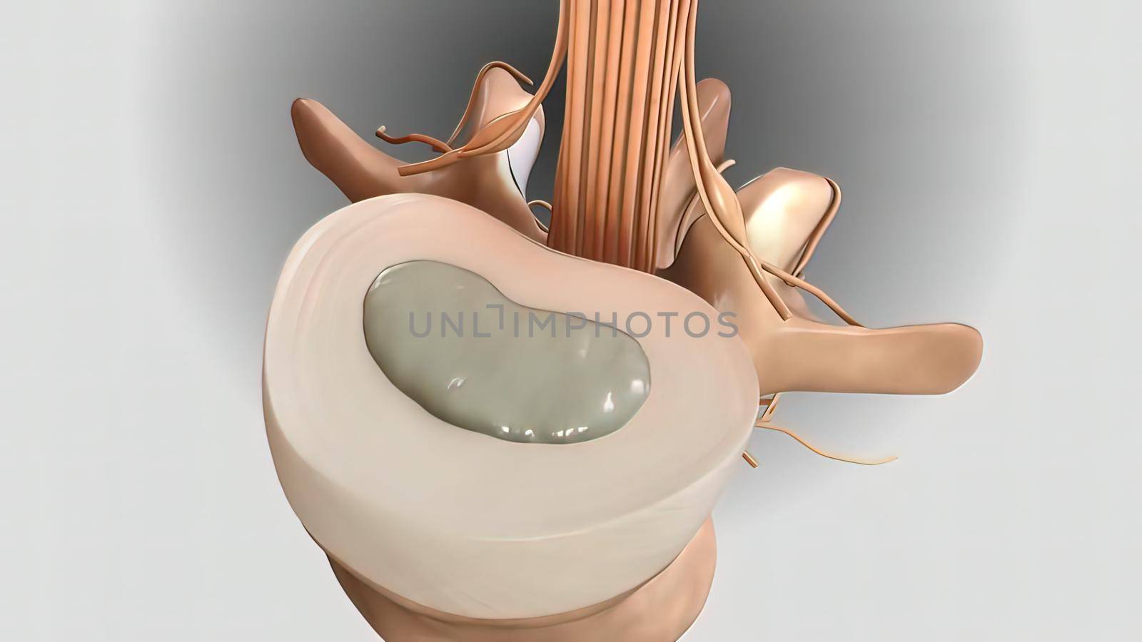Pressure applied to the nerve as a result of the fracture of the spinal disc 3D illustration