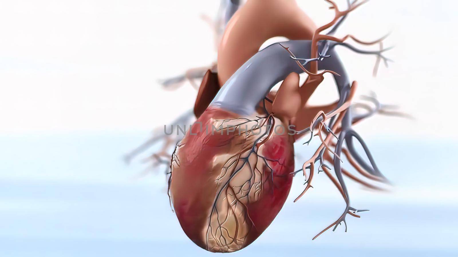 Acute Coronary Syndrome 3D illustration