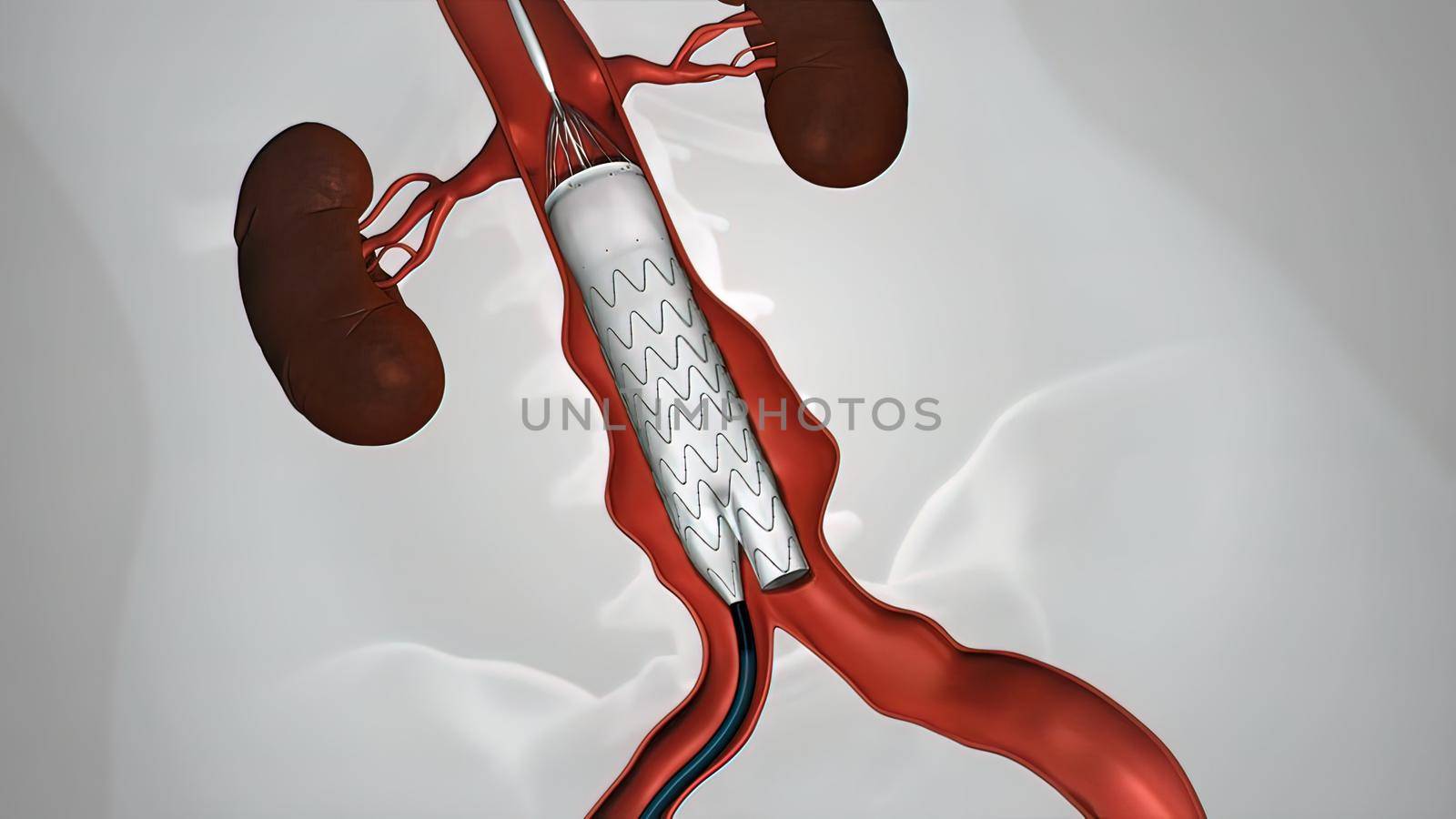 balloon angioplasty procedure with stent in vein 3D illustration