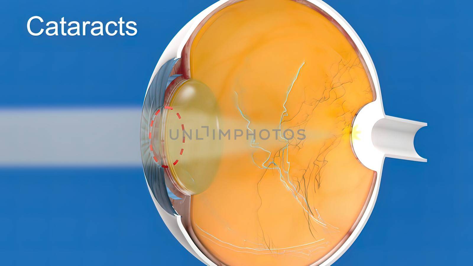 Cataract, clouding of the lens of the eye that causes decreased vision. 3D Medical illustration