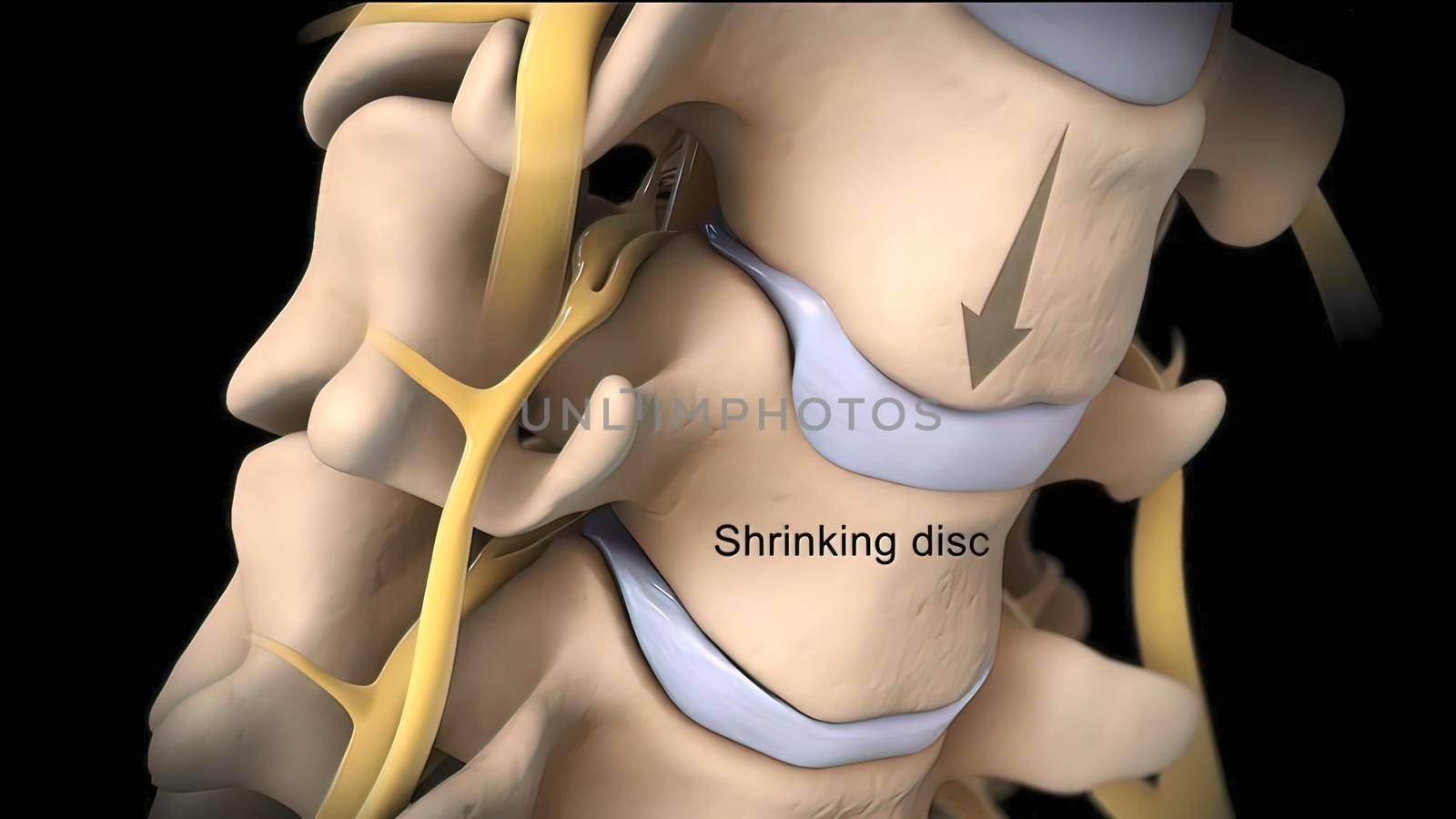 Pressure applied to the nerve as a result of the fracture of the spinal disc 3D illustration