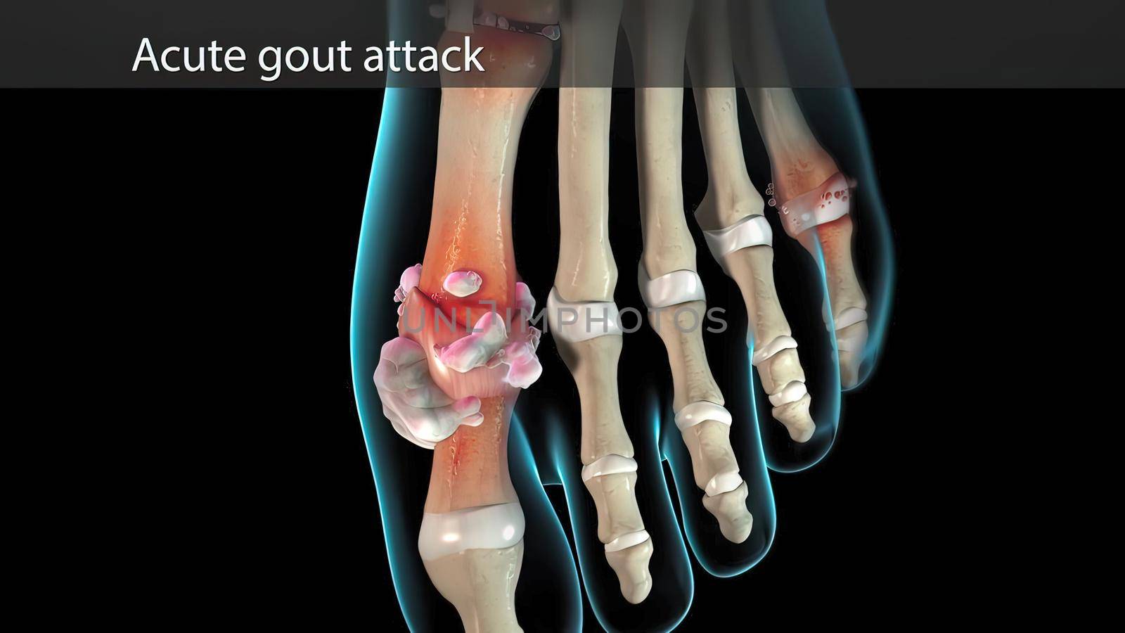 Gout is a form of arthritis. Sudden, severe attacks of pain, swelling