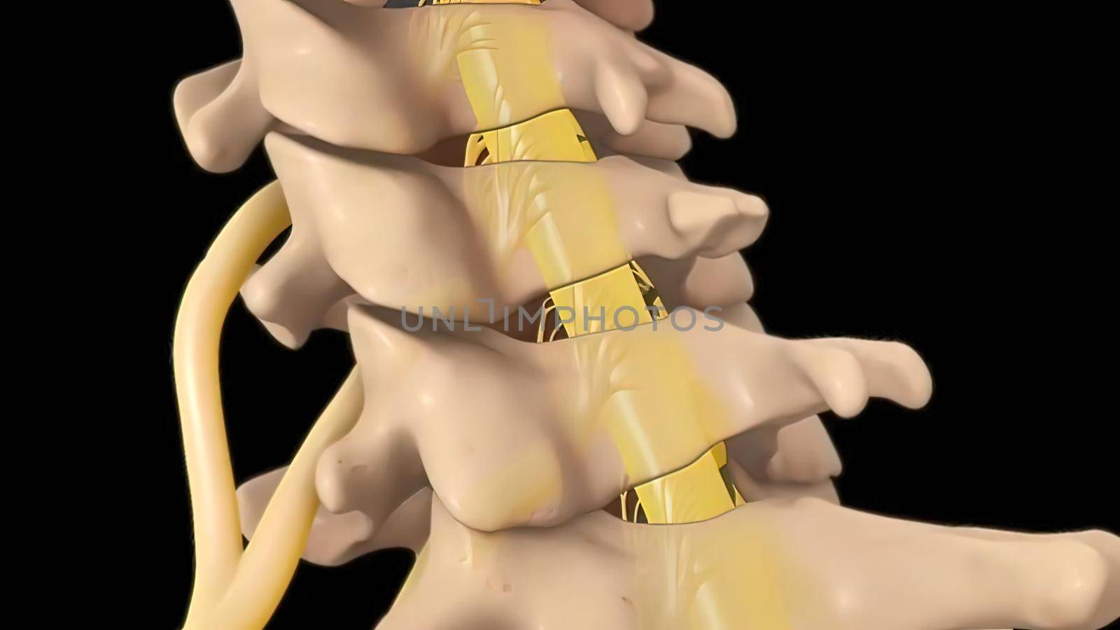 Anatomical view of the cervical spine with intervertebral disc-compressive nerve root prolapse. 3D illustration