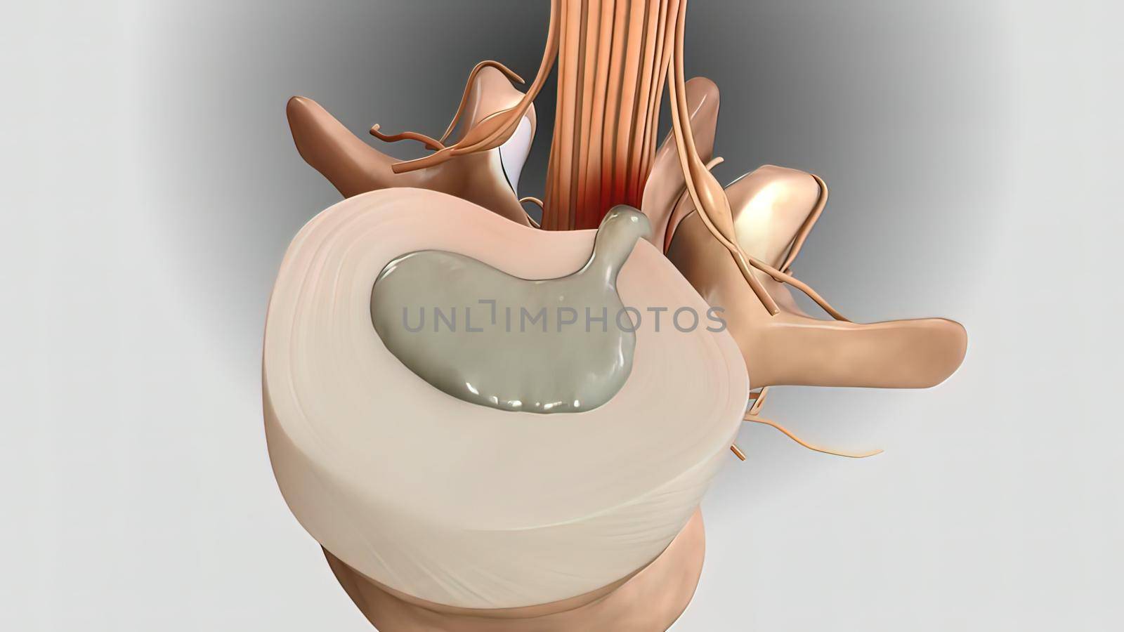 Pressure applied to the nerve as a result of the fracture of the spinal disc 3D illustration