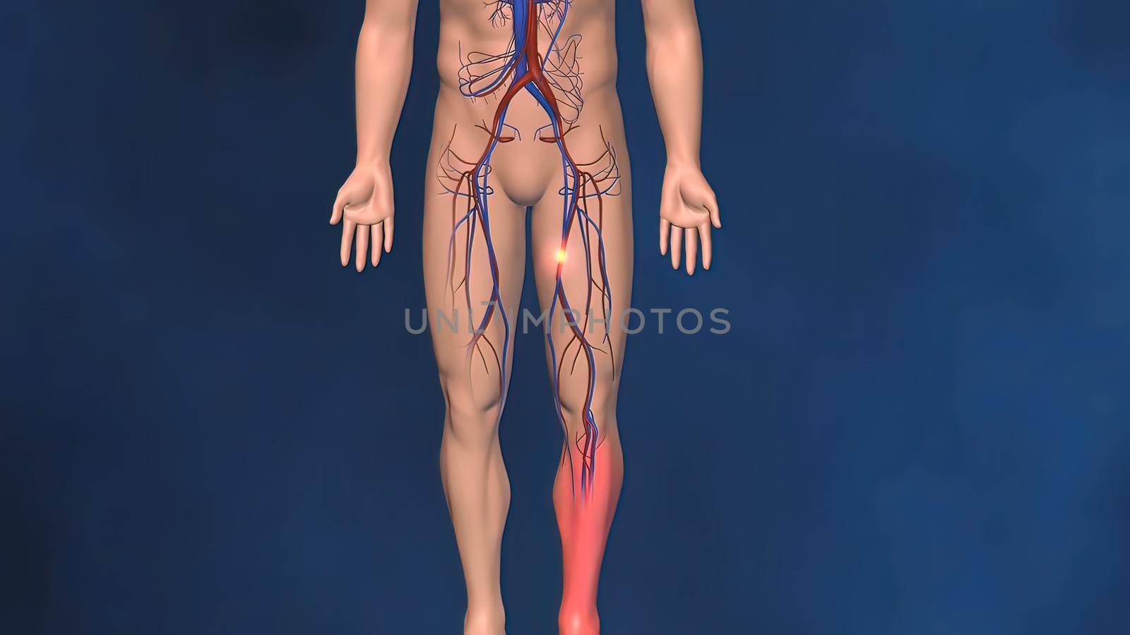 Blood clots are semi-solid masses of blood that can be stationary (thrombosis) and block blood flow or break loose (embolism) 3D Illustration