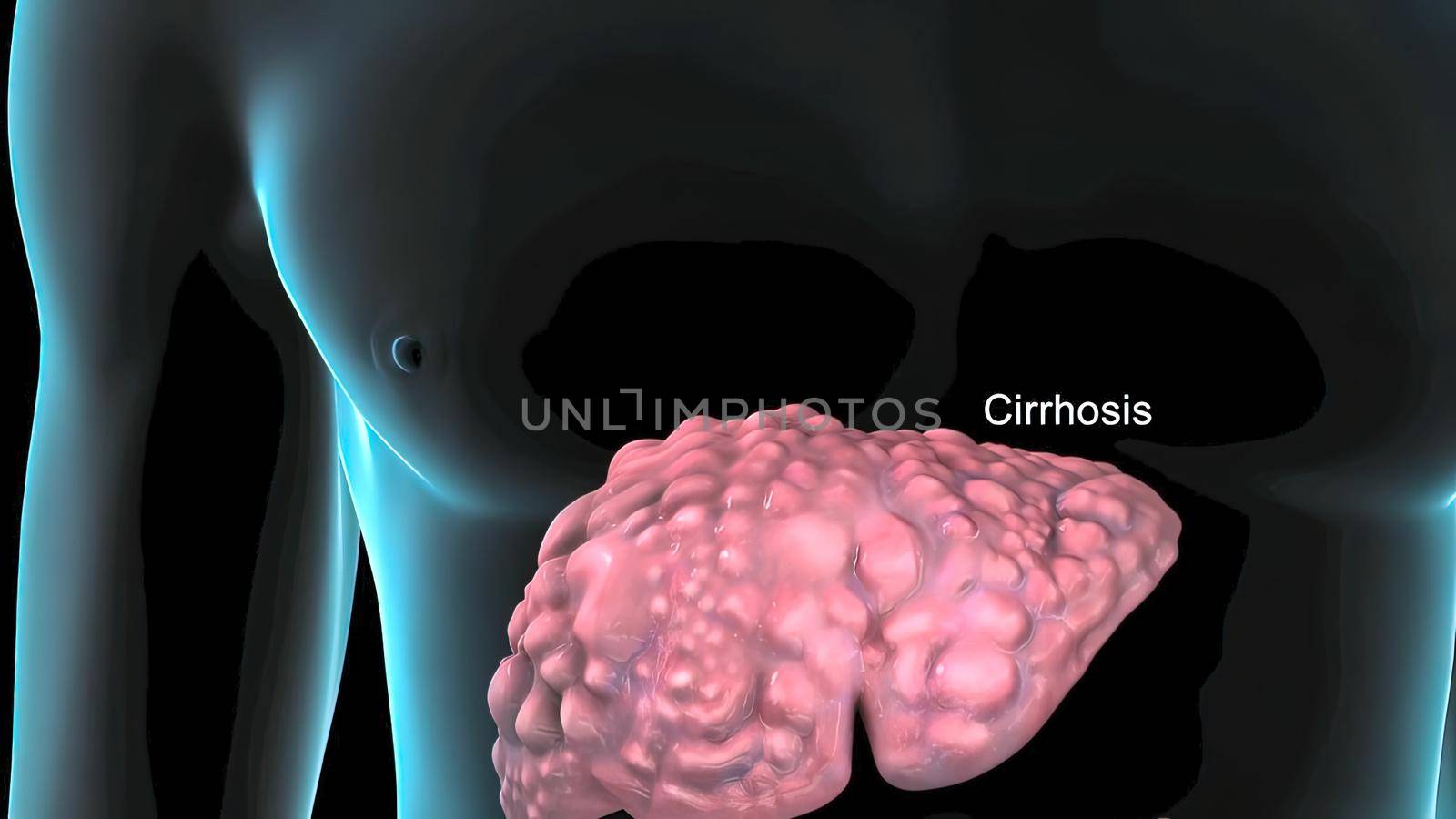 Cirrhosis is the result of long and continuous damage to the liver. by creativepic