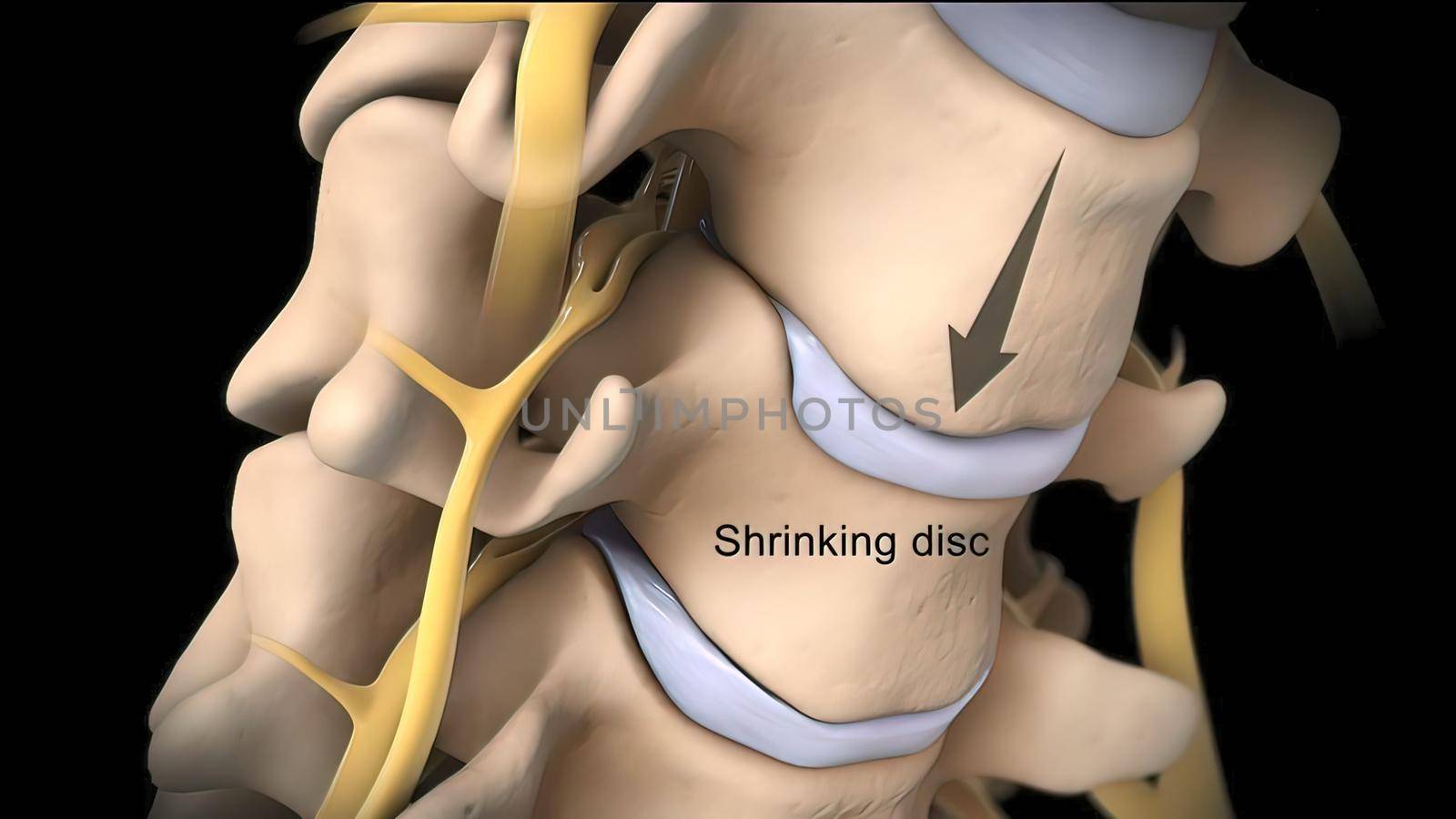 Central disc protrusion top view 3D illustration