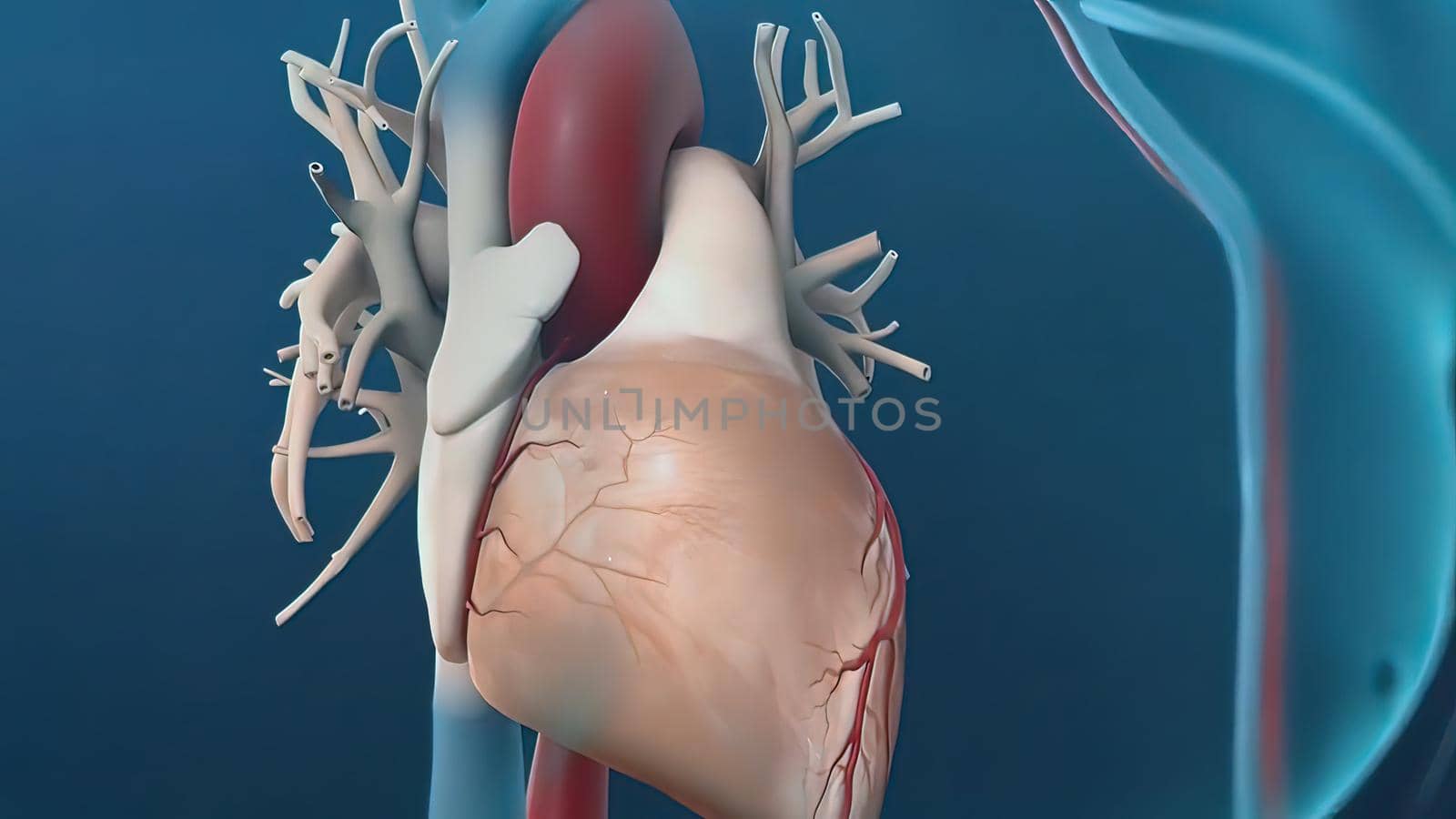 A coronary angioplasty is a procedure used to widen blocked or narrowed coronary arteries (the main blood vessels supplying the heart). 3D illustration