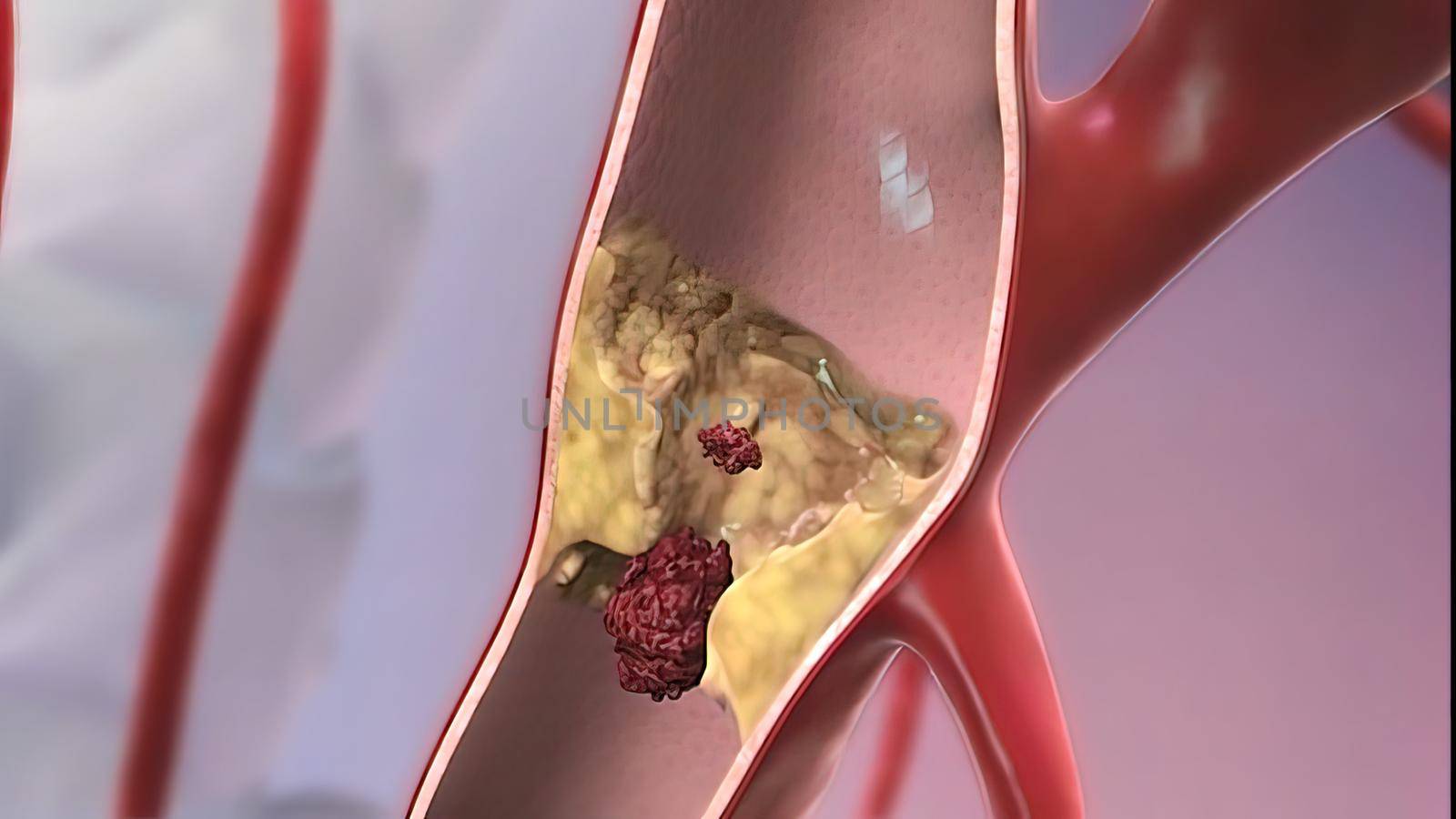 3D illustration showing blood supply to the brain and highlight of the circle of Willis, formation of aneurysm and its rupture.