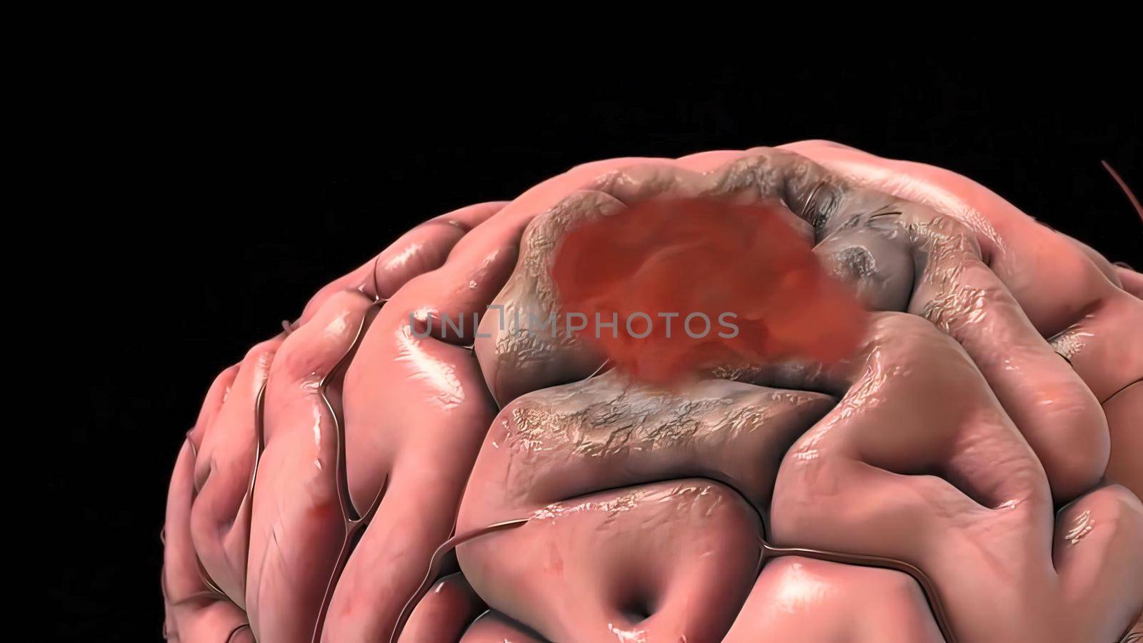 A brain aneurysm is a bulge or ballooning in a blood vessel in the brain. 3D illustration