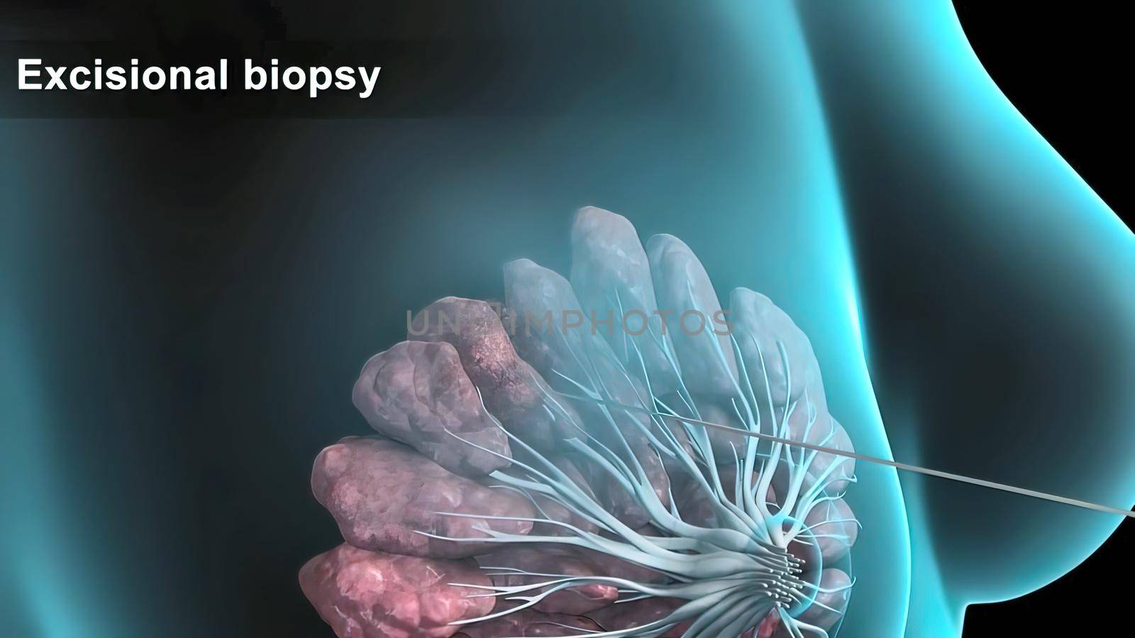 Breast cancer Girl with breast pathology. . Illustration and close-up of female human structure. 3D illustration