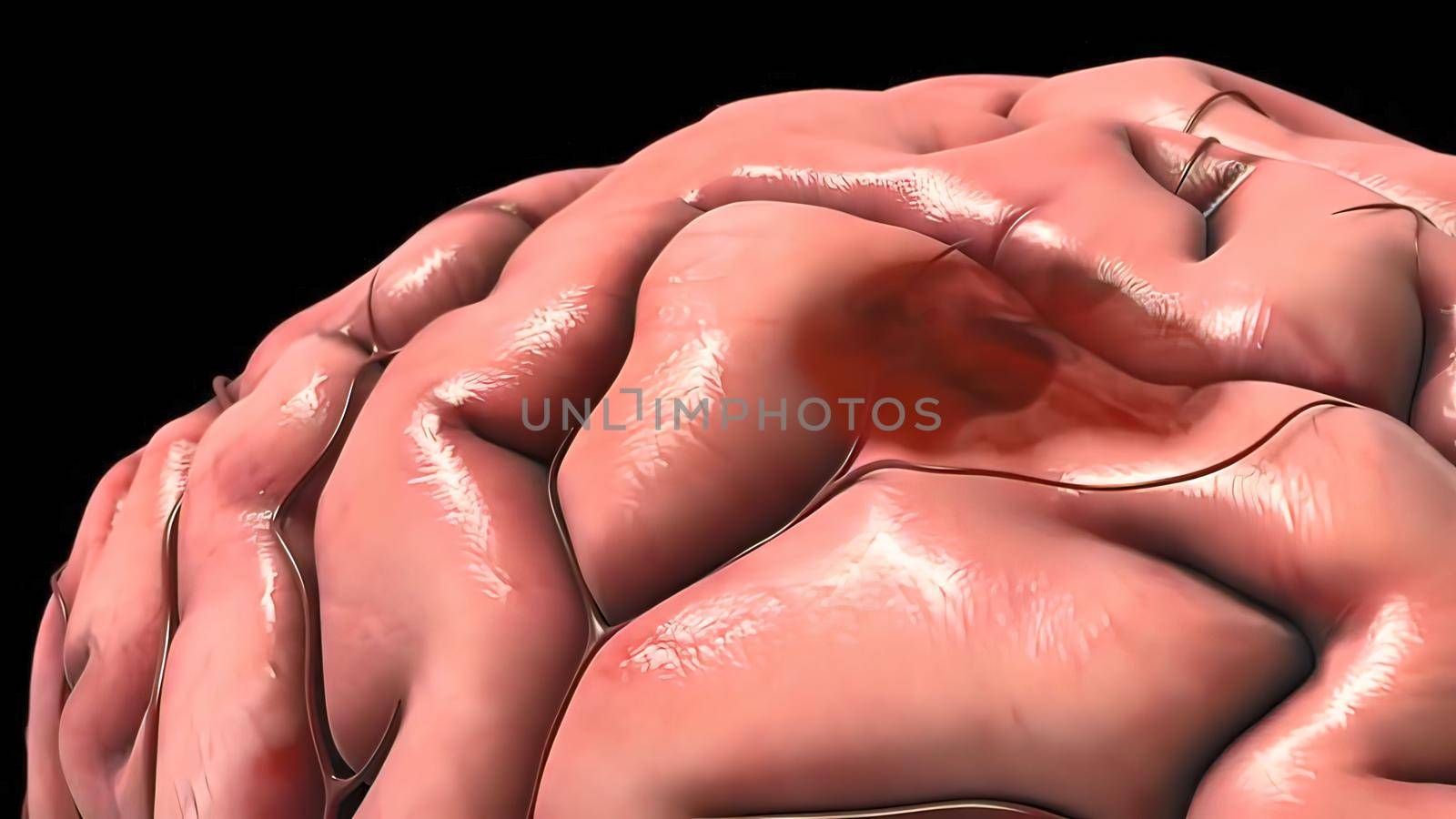 A brain aneurysm is a bulge or ballooning in a blood vessel in the brain. 3D illustration