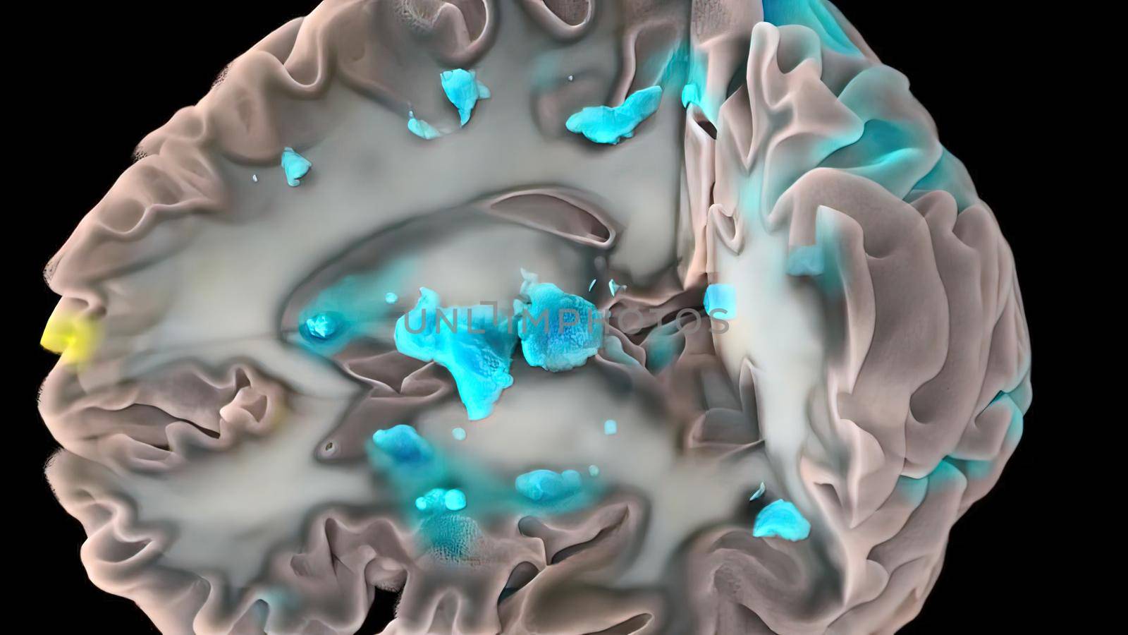 3D Medical 3D illustration of human brain Colourful Neuronal Activity on black background