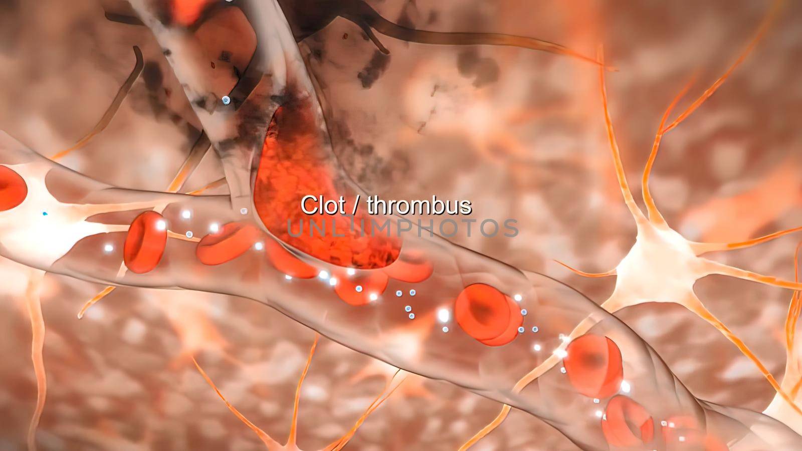 Brain Hemorrhagic Stroke Due To Aneurysm Rupture. 3D illustration