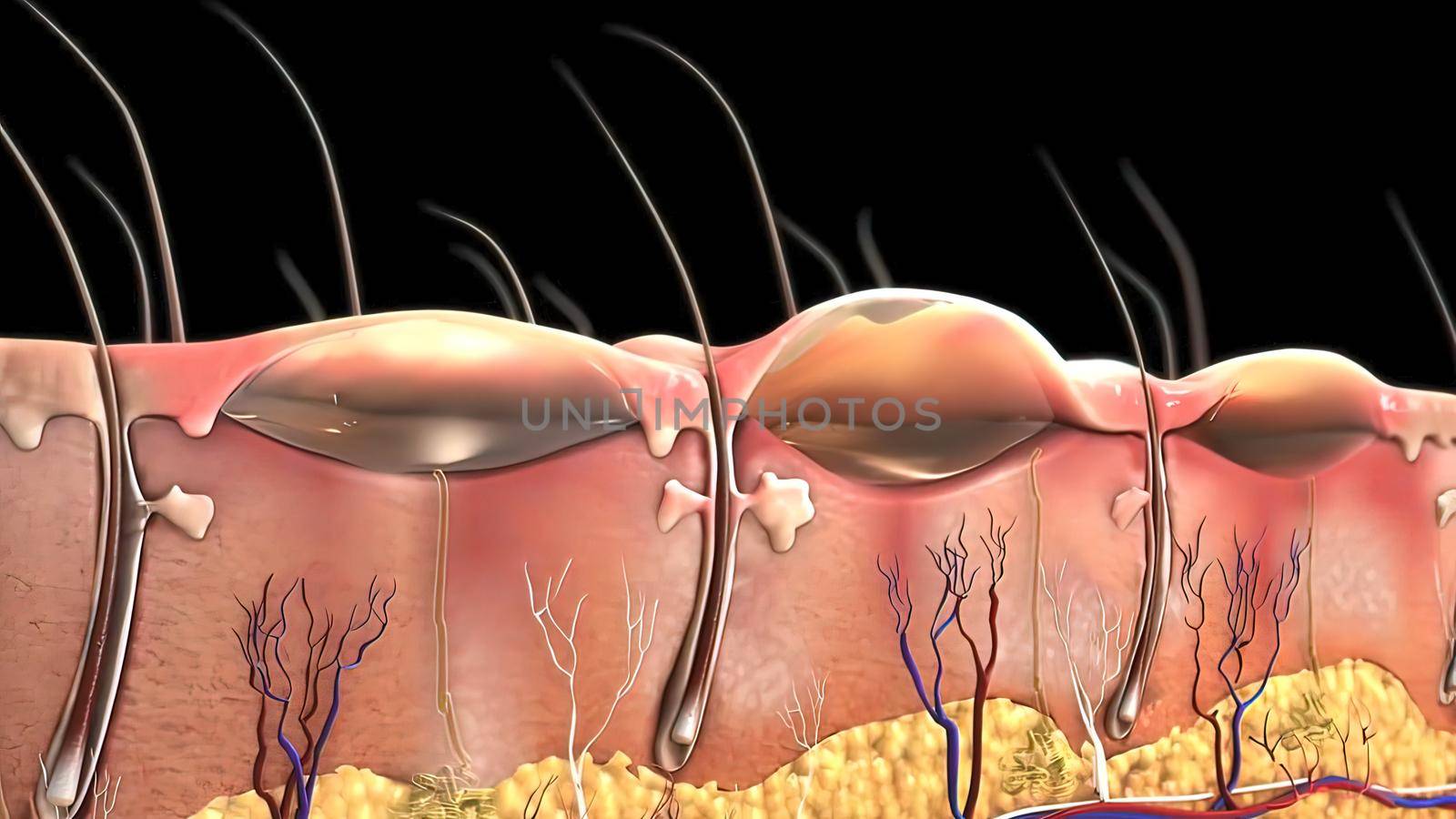 First Degree Burn epidermis 3d by creativepic