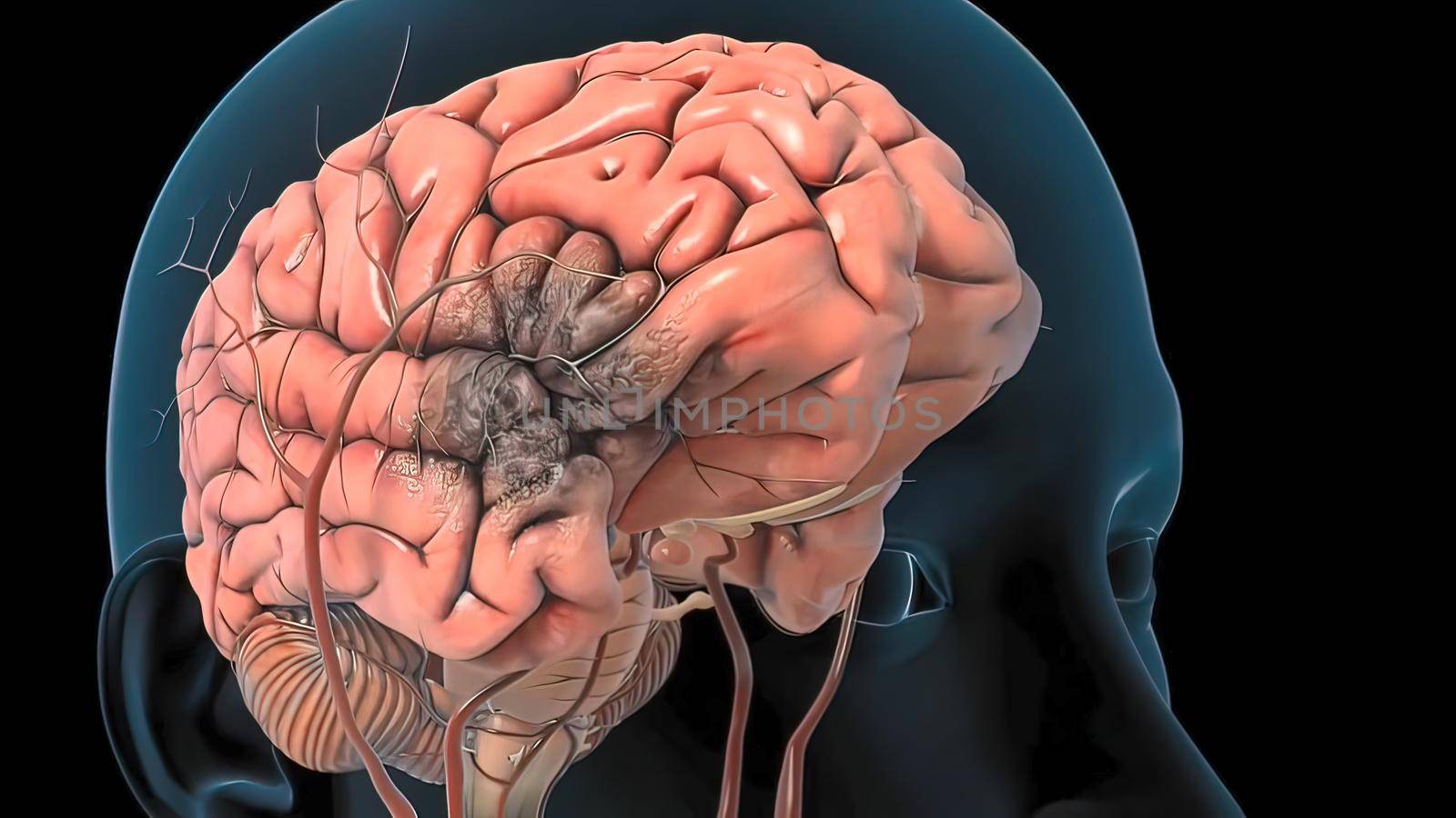 Brain Hemorrhagic Stroke Due To Aneurysm Rupture. 3D illustration