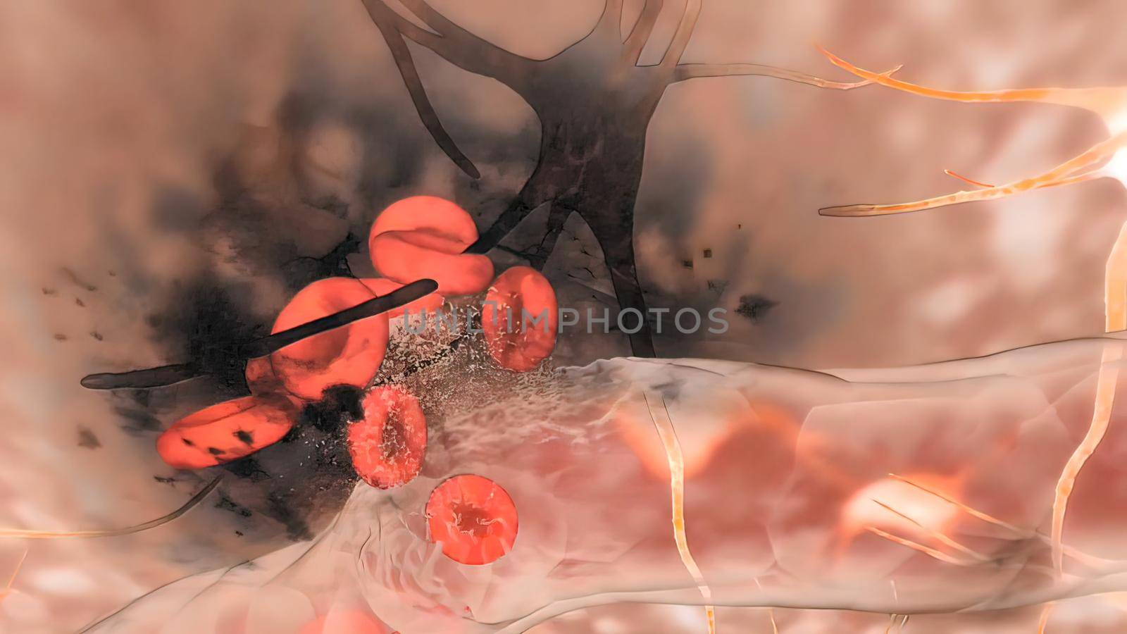 Cerebral hemorrhage as a result of an aneurysm bursting in the brain by creativepic