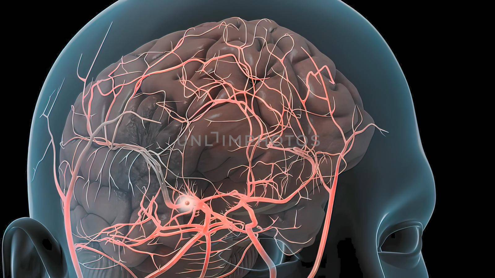 A brain aneurysm can leak or rupture, causing bleeding into the brain (hemorrhagic stroke). 3D illustration