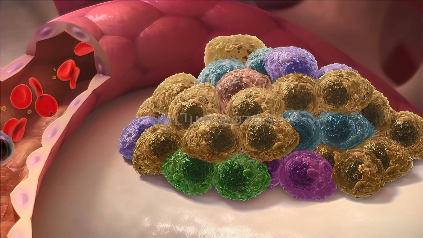 Multiple Myeloma, a type of cancer that consists of white blood cells and its spread. 3D illustration