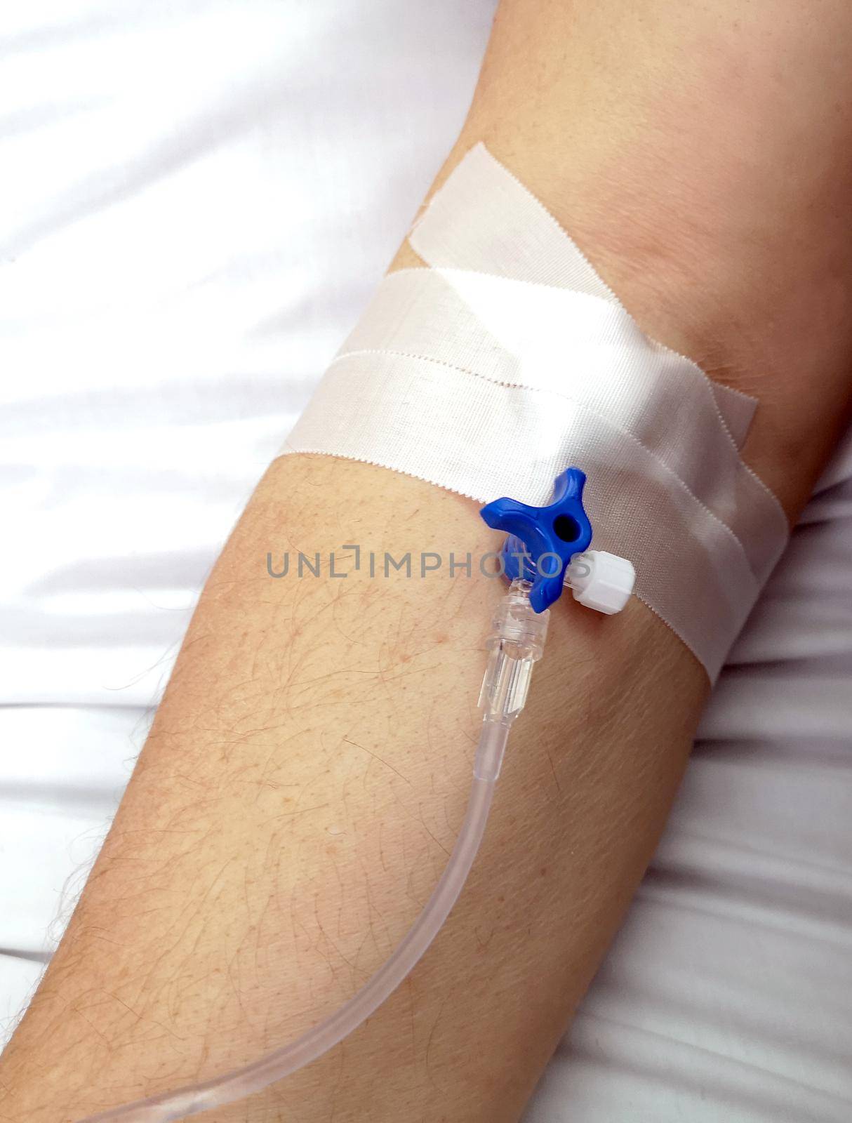 Close up of patient arm with perfusion tube in an hospital receiving medical treatment