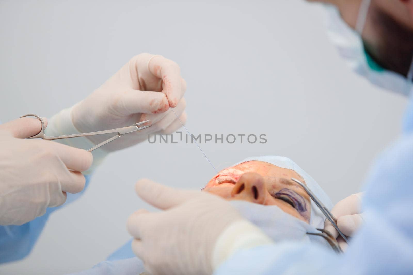 Blepharoplasty, plastic surgery operation for correcting defects, deformities, and disfigurations of the eyelids.