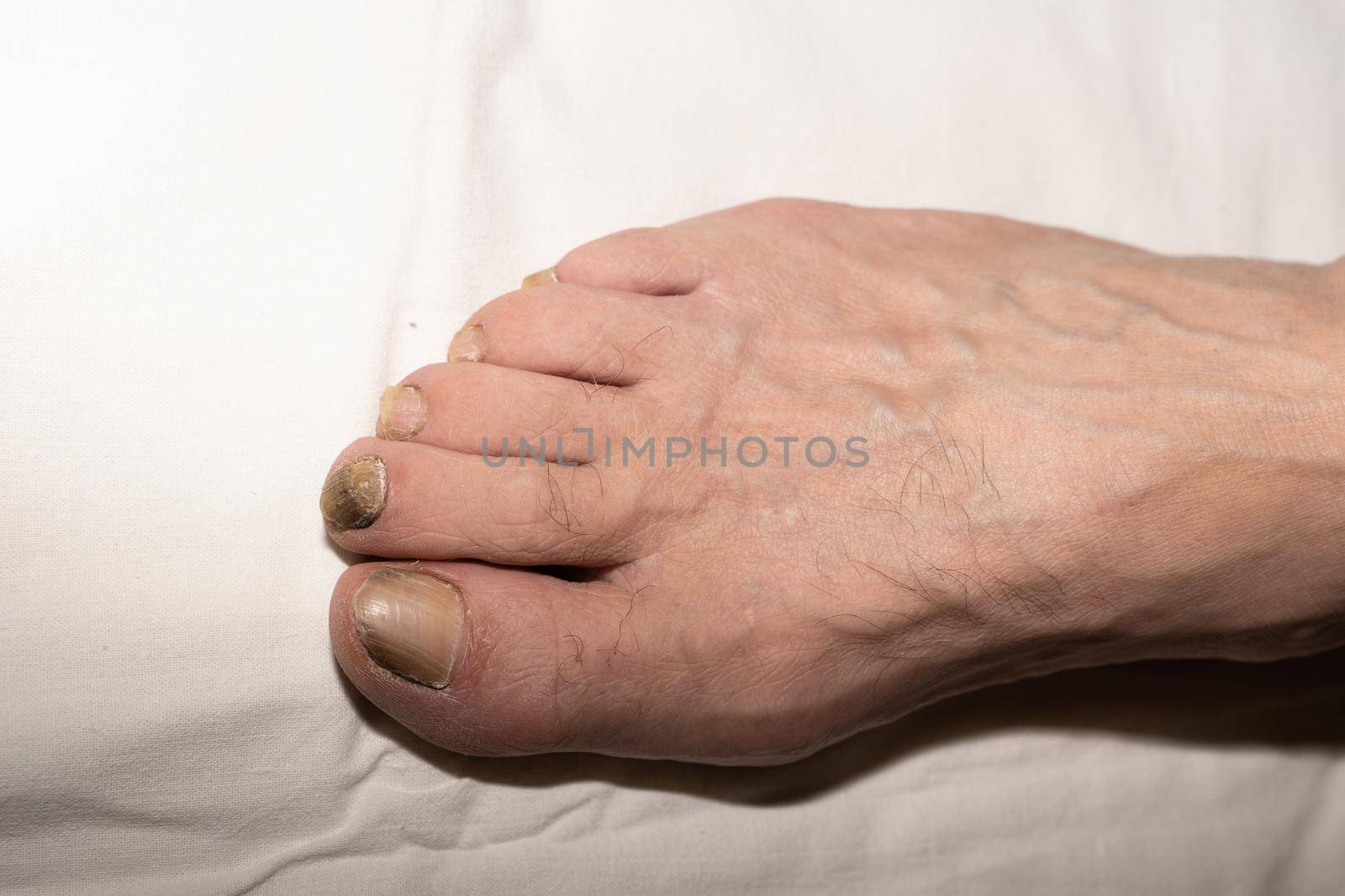 The nails on the right foot of a man of retirement age are delaminated due to age, are affected by a yellow fungus