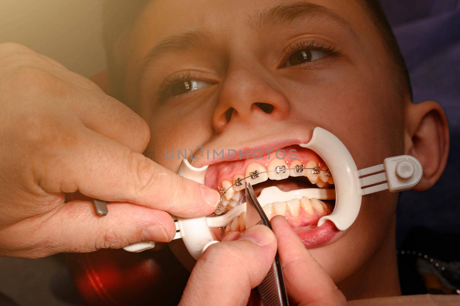 The teenager's boy is glued braces on his upper teeth to straighten them, the boy has a retractor on his lips, a hook for straightening braces.