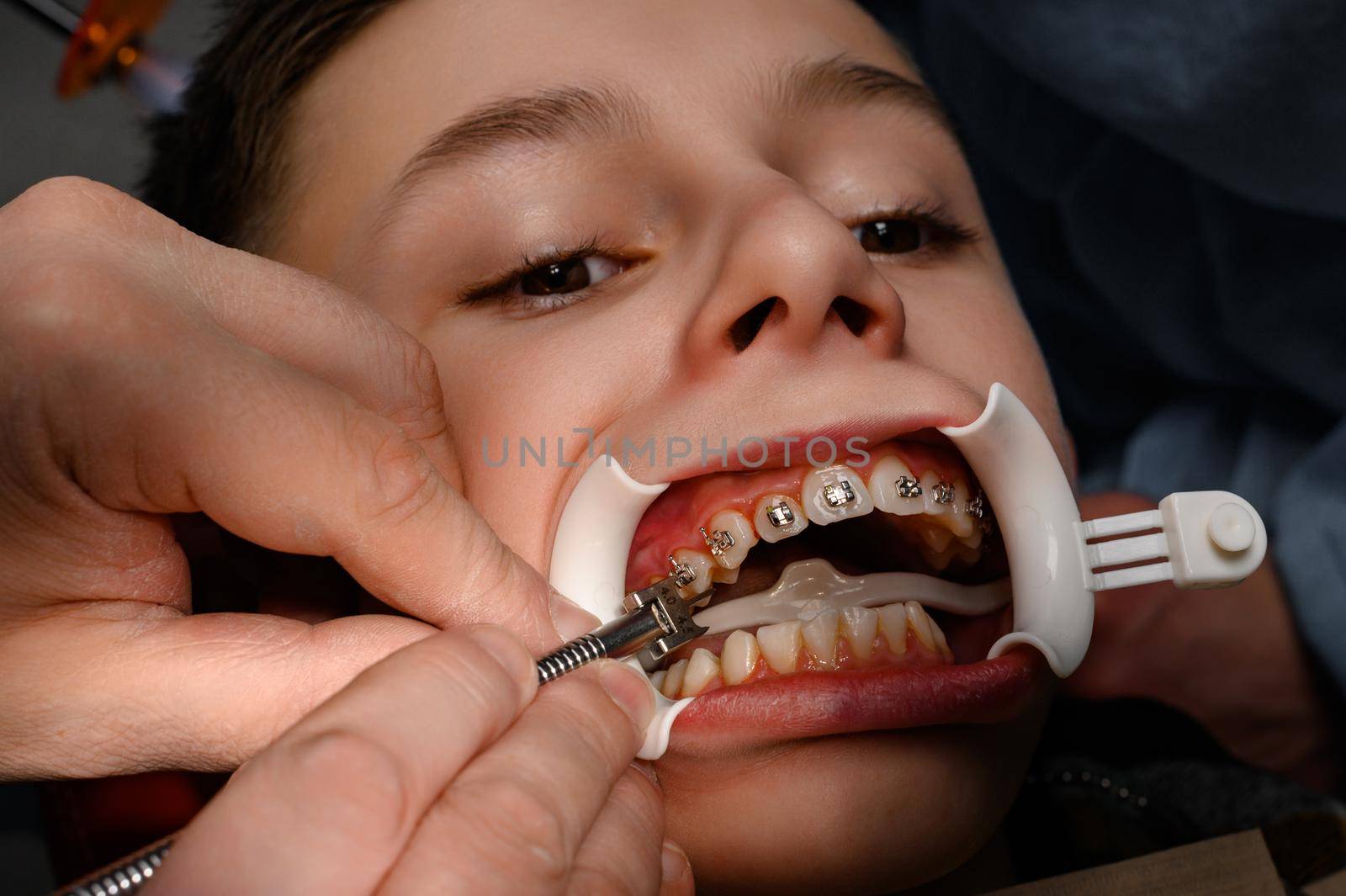 White retractor on the lips and the installation of metal braces on the upper teeth of the teenager, crooked teeth and align them with braces.