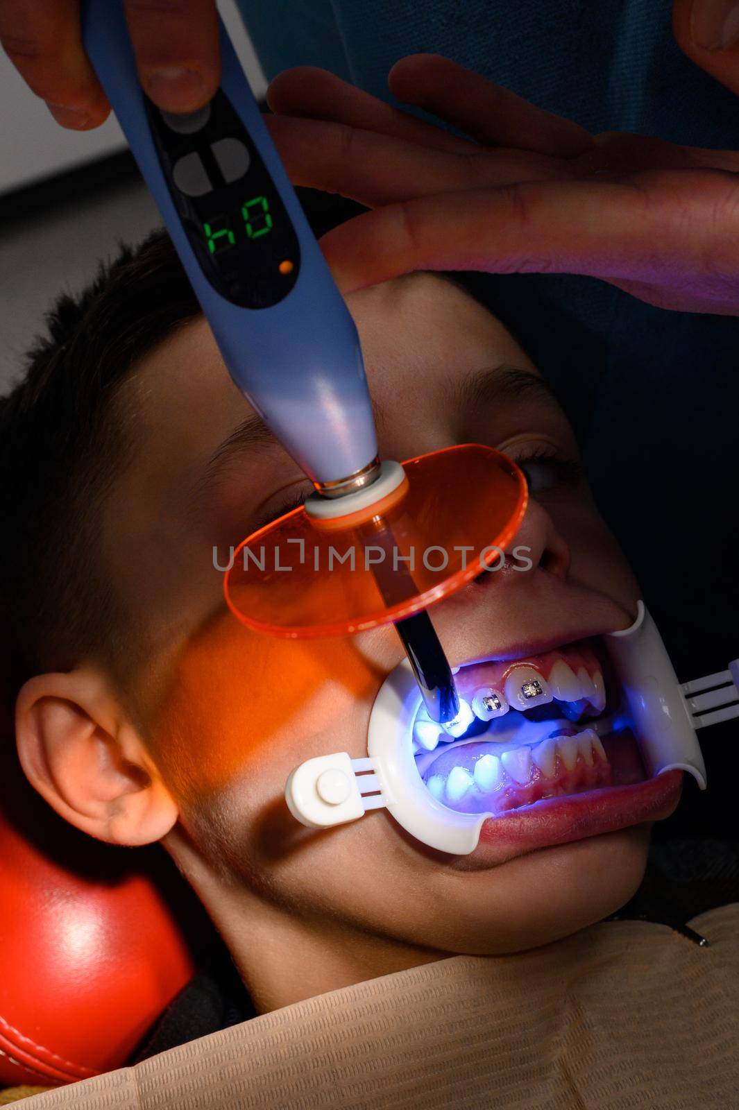Alignment of crooked teeth with the help of braces, installation of braces for a child, an orthodontist glues metal plates braces for teeth alignment, ultraviolet for quick drying of the glue.