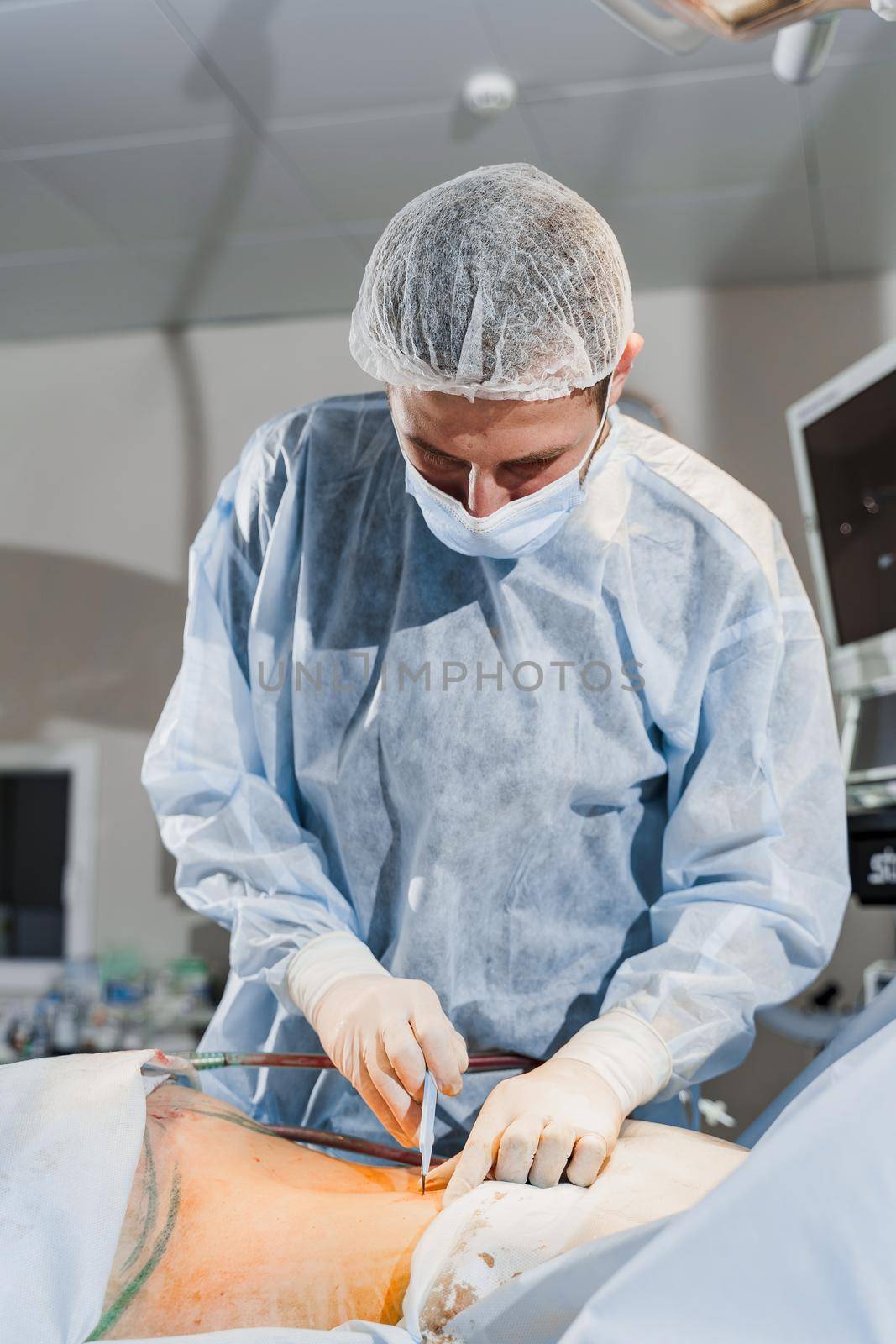 Surgeon removes fat in the gluteal region. Abdominoplasty - plastic operation to reduce the abdomen and remove cellulite by Rabizo