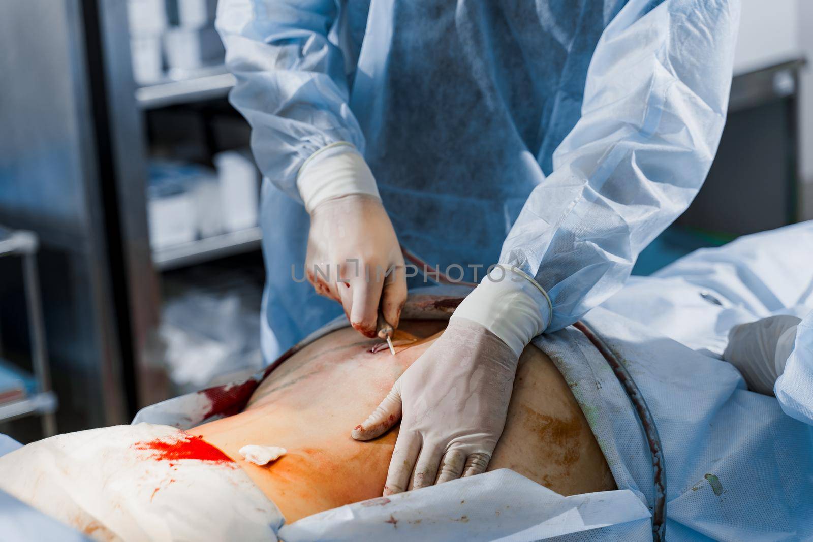 Liposuction close up. Surgeon does abdominoplasty plastic operation to reduce the abdomen and remove cellulite. Correcting body shape by Rabizo
