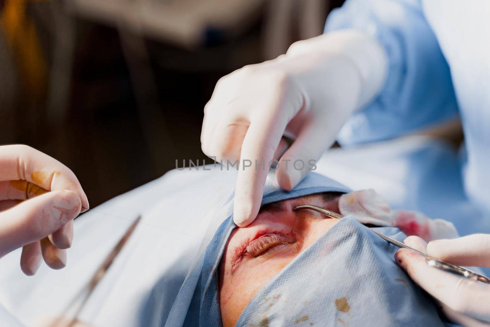 Blepharoplasty plastic surgery operation for modifying the eye region of the face in medical clinic. Surgeon sutures the eyelid. by Rabizo