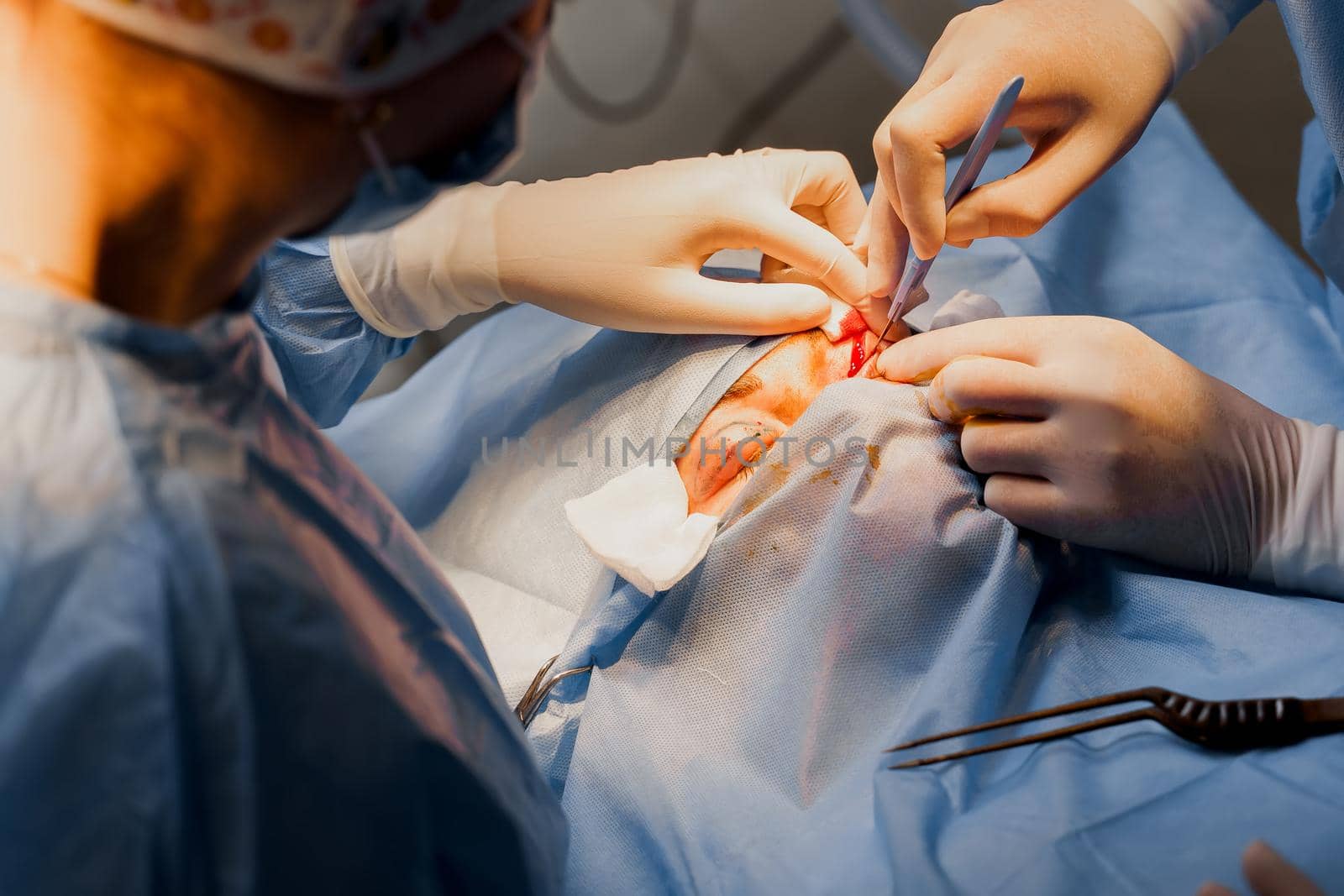 Blepharoplasty plastic surgery operation for modifying the eye region of the face in medical clinic. Surgeon makes an incision with a surgical knife