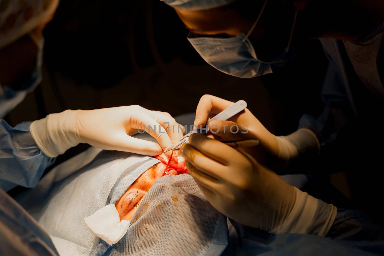 Blepharoplasty plastic surgery operation for modifying the eye region of the face in medical clinic. Surgeon makes an incision with a surgical knife. by Rabizo
