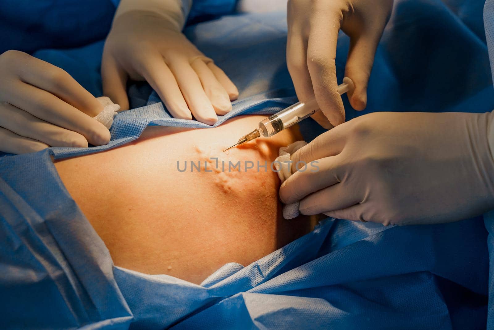 Close-up anesthesia thigh injection before blepharoplasty and lipofilling plastic surgery operation for modifying the eye region of the face