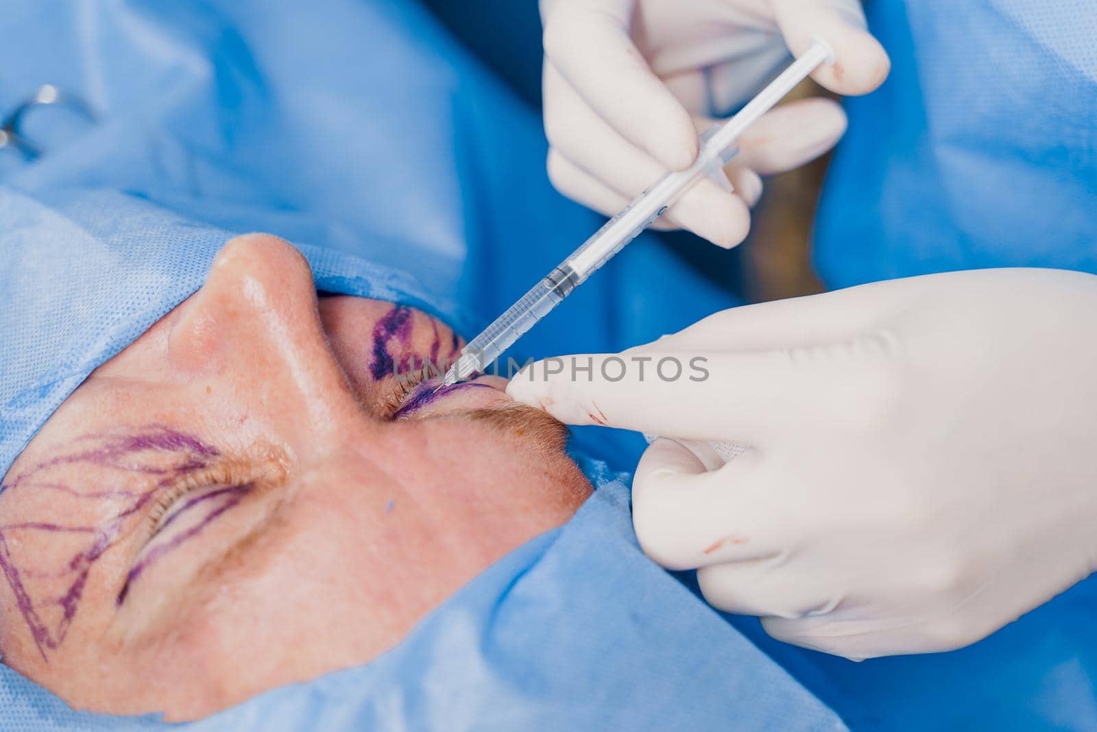 Close-up anesthesia before blepharoplasty and lipofilling plastic surgery operation for modifying the eye region of the face in medical clinic