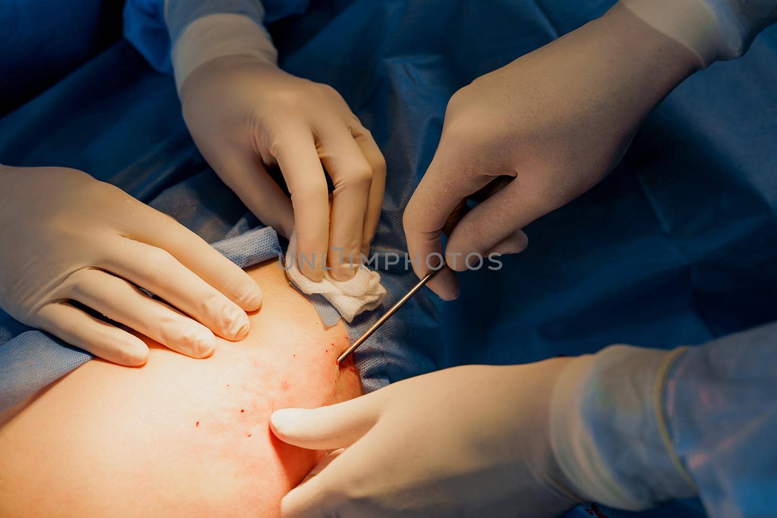 Liposuction for lipofilling surgery operation. close-up photo of 2 surgeon do plastic surgery named blepharoplasty in medical clinic.