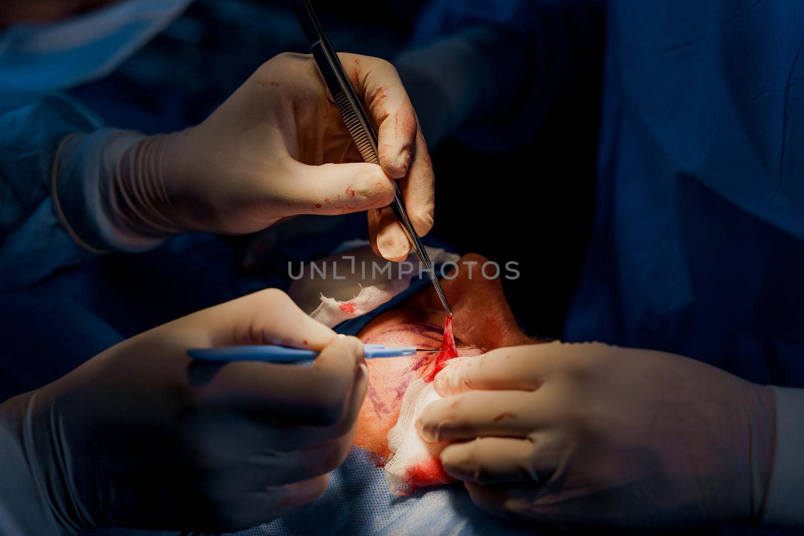 Close-up blepharoplasty lipofilling plastic surgery operation for modifying the eye region of the face in medical clinic