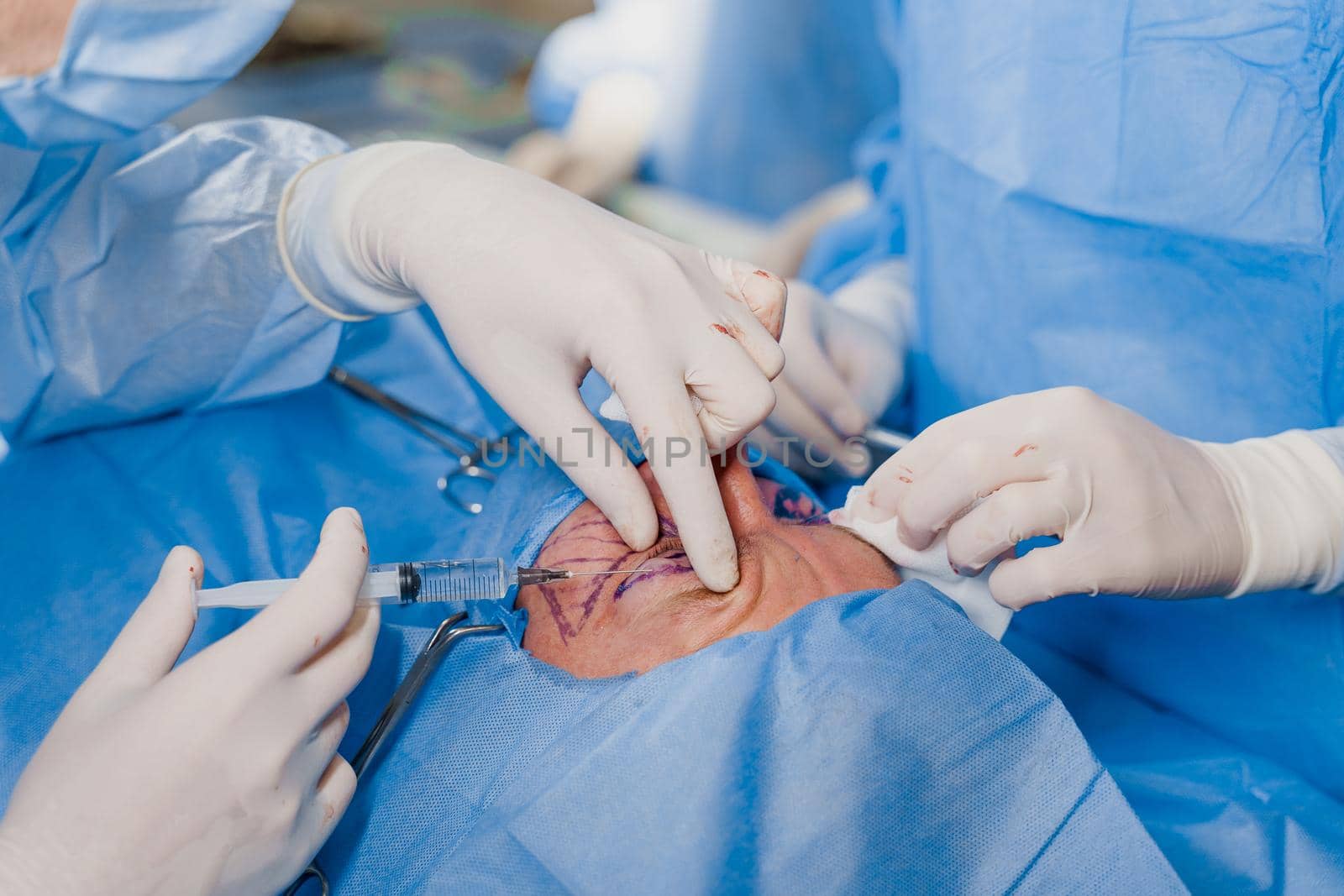 Close-up anesthesia before blepharoplasty and lipofilling plastic surgery operation for modifying the eye region of the face in medical clinic