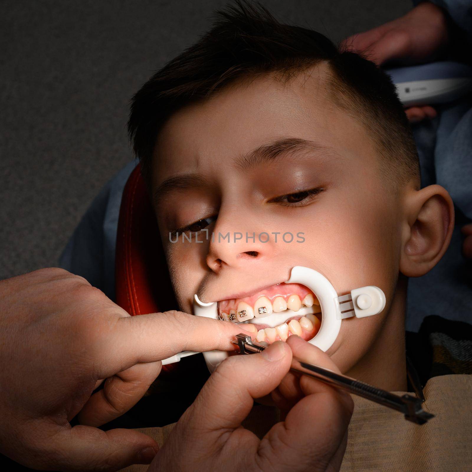 Close up of installing braces on teeth, aligning teeth with braces, retractor on lips, visit to dentist.