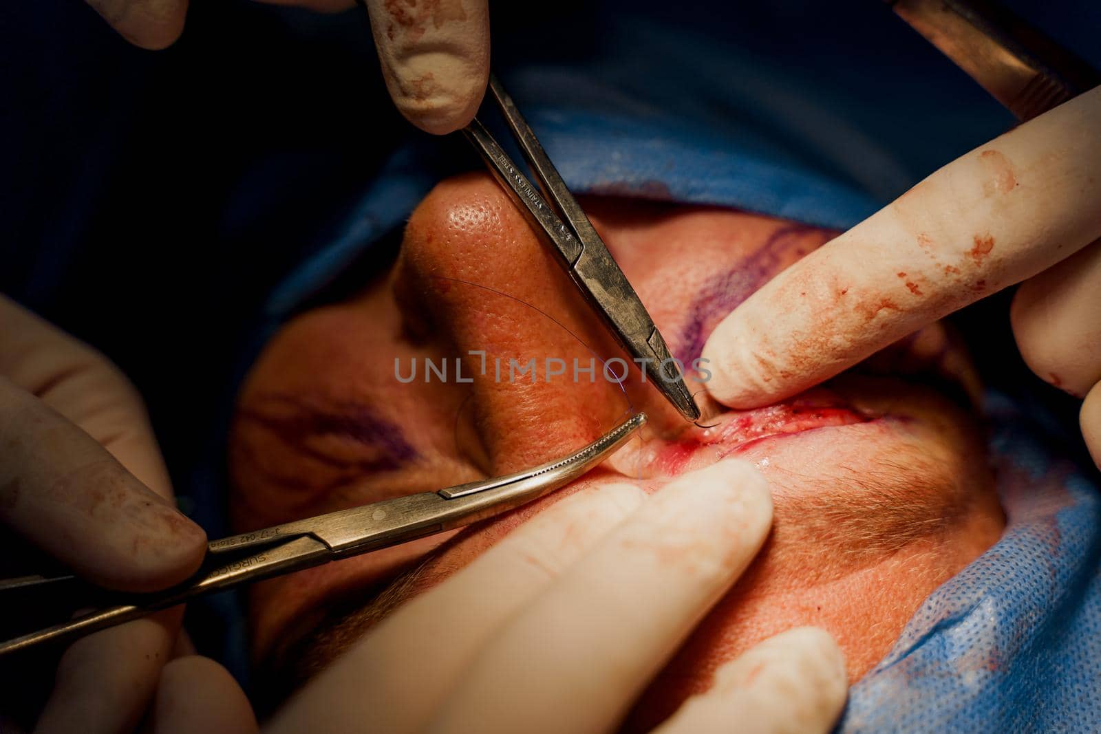 Close-up blepharoplasty lipofilling plastic surgery operation for modifying the eye region of the face in medical clinic. Surgeon sutures the eyelid, by Rabizo